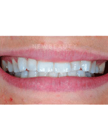 Dr. Guy Lewis Veneers - Before
