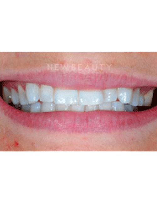 Dr. Guy Lewis Veneers - Before