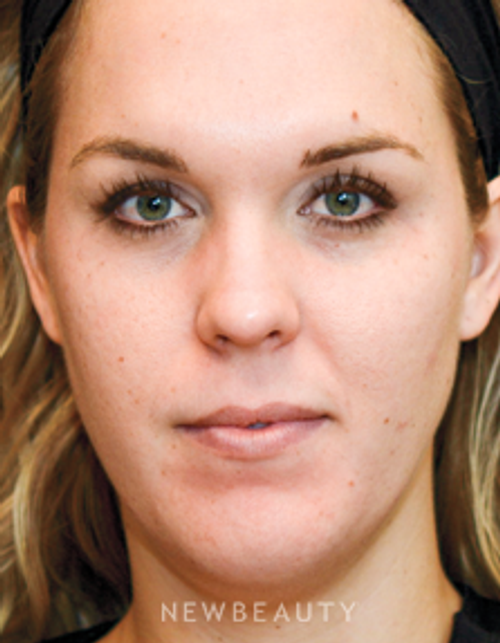 Dr. Janet Allenby - Nonsurgical Facial Contouring - Before