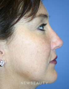 Dr. Kelly Bomer, Rhinoplasty - After