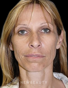 Ordon & Chopra - Facial Rejuvenation - Before