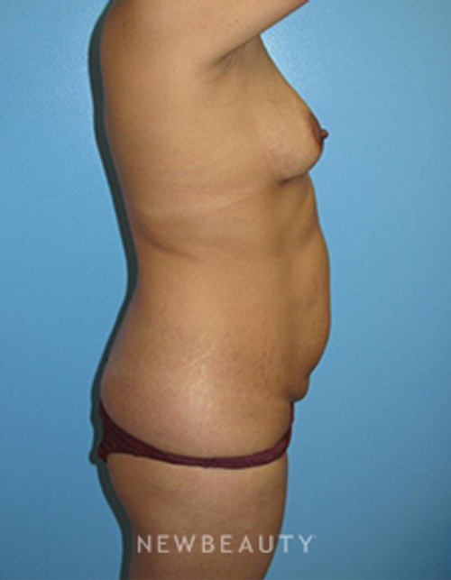 Dr. B. Aviva Preminger - Mommy Makeover - Before