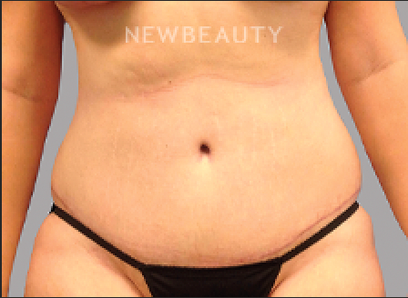 DR. AMY M. SPROLE - Tummy Tuck - 46920185 - After