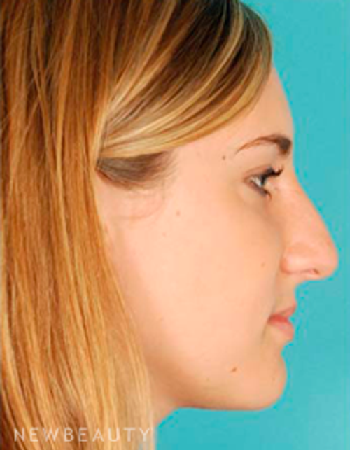 Dr. David Kim Rhinoplasty - Before