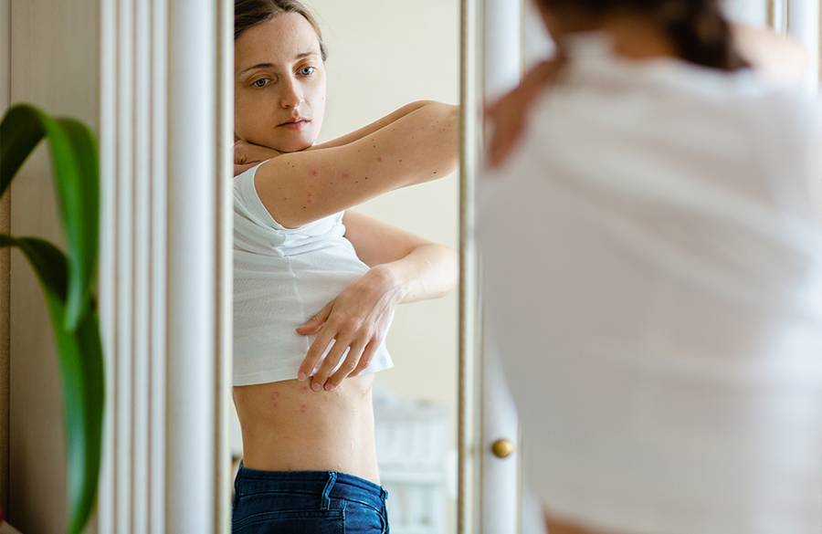 The FDA Just Approved a Major Treatment Innovation for Plaque Psoriasis