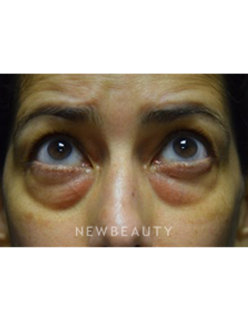 Dr. Jeffrey B. Wise - Blepharoplasty - Before