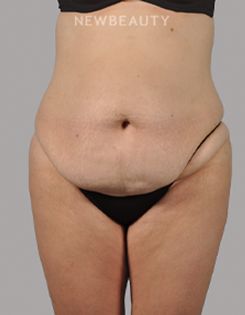Dr. David Alfonso - A New, Improved Contour - 20903552 - Before