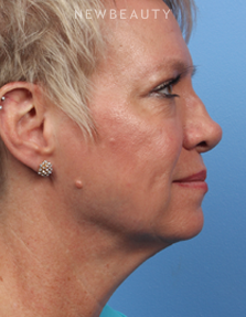 Dr. James Bouzoukis - Nonsurgical Rhinoplasty - Before