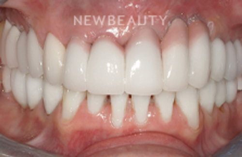 Dr. Hamid Atabakhsh - Dental Implants - 46426321 - After