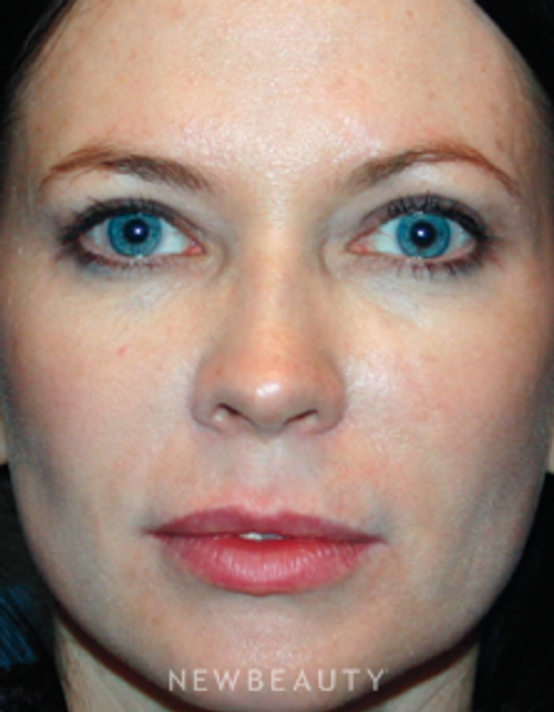 Dr. Kelly Bomer Blepharoplasty - After