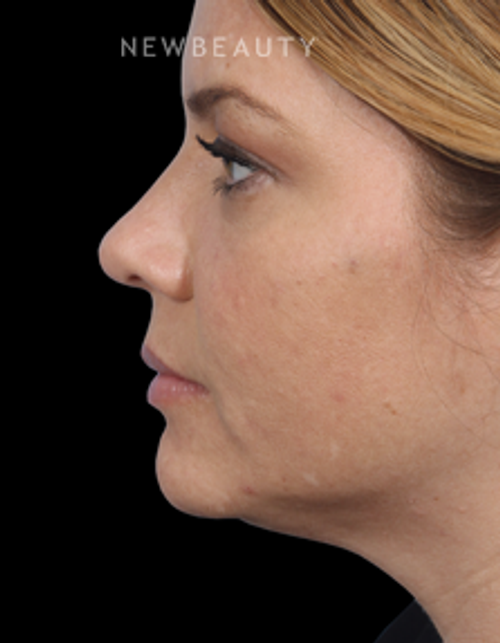 Dr. Kathleen Behr - Double Chin Reduction - After