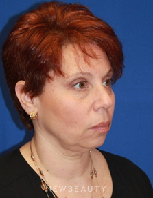 Dr. Dilip Madnani - Ultherapy - Before