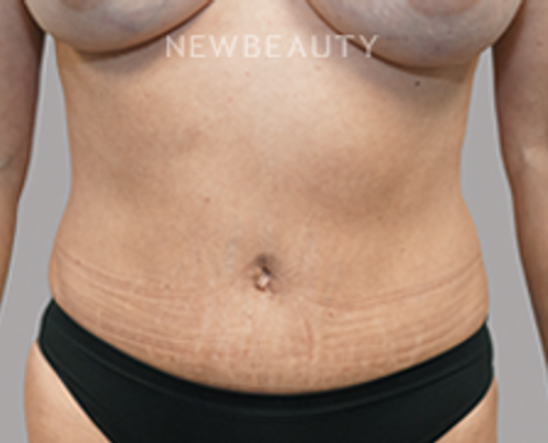 Dr. Jeffrey R. Antimarino - Tummy Tuck - 25108174 - After
