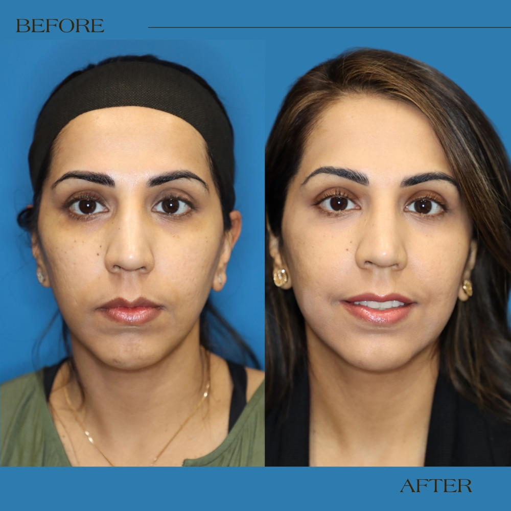 before and after MIRIA laser