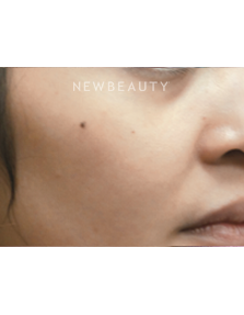 Dr. Jody Levine - Laser Skin Resurfacing - After