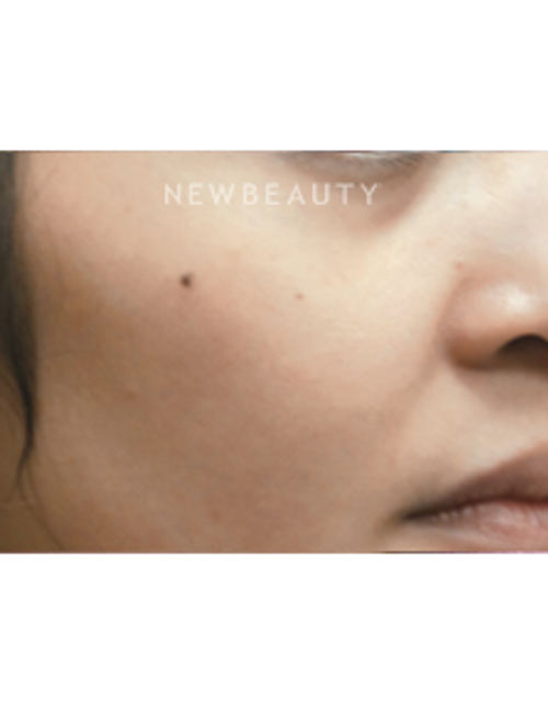 Dr. Jody Levine - Laser Skin Resurfacing - After