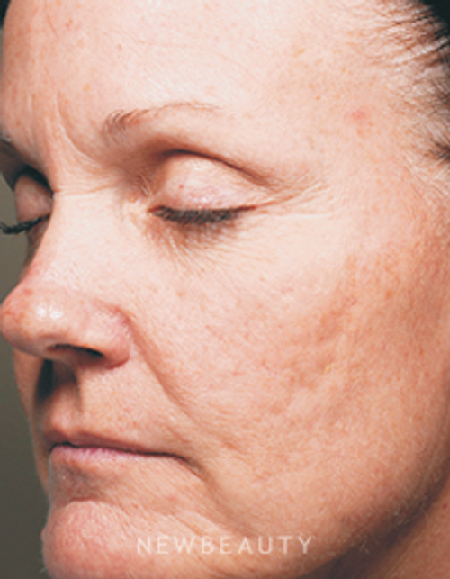 Dr. Girish Munavalli Acne Scar Treatment - Before