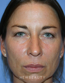 Dr. Kelly Bomer, Blepharoplasty, Browlift/Forehead Lift, Facelift, Chin Augmentation - Before