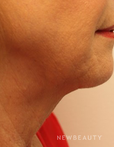 Dr. Kimberly Lee- Facelift - Before