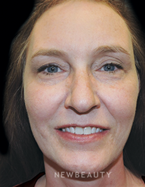 Dr. Joel Schlessinger - Youthful Rejuvenation - After