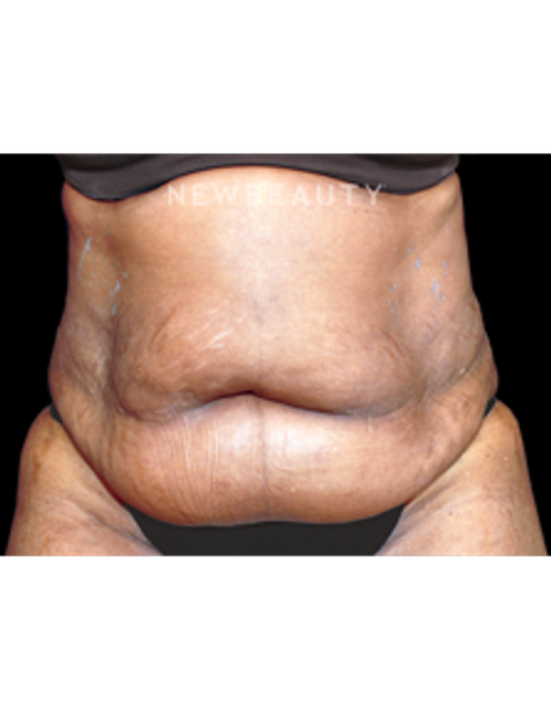 Dr. Steven P. Bloch - Streamlined Silhouette - Before