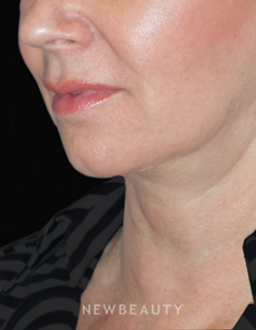 Dr. Min Ahn - Facelift, Necklift, Laser Treatment - After