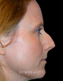 Dr. Kelly Bomer Rhinoplasty - Before