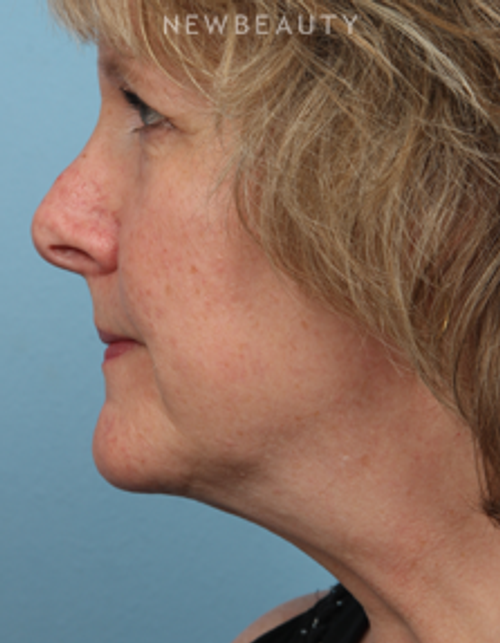 Dr. Kathleen Behr - CoolSculpting - After