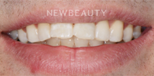 Dr. Nathan Hoffman - Teeth Whitening & Veneers - Before