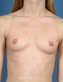 Dr. Bradley Calobrace Breast Augmentation - Before