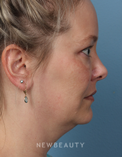Dr. Kathleen Behr - SmartLipo - Before
