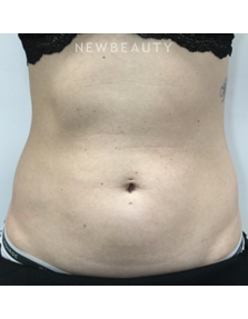 Dr. Julie Russak - Fat Reduction - Before