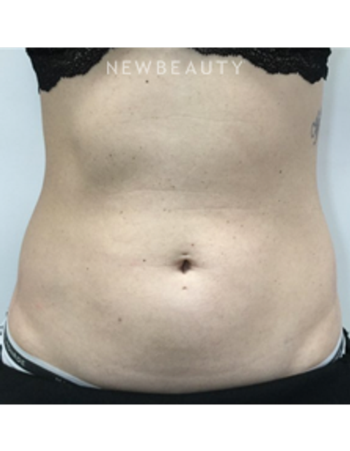 Dr. Julie Russak - Fat Reduction - Before