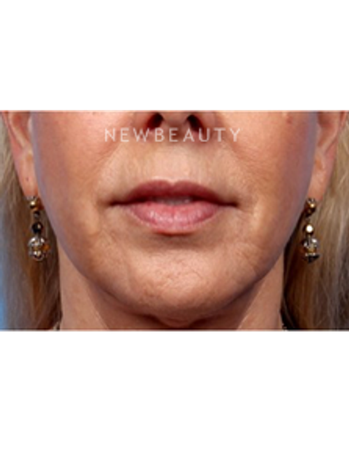 Dr. Kelly Bomer - Lips - After