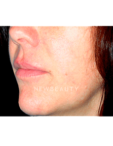 Dr. Kelly Bomer Lip Augmentation - Before