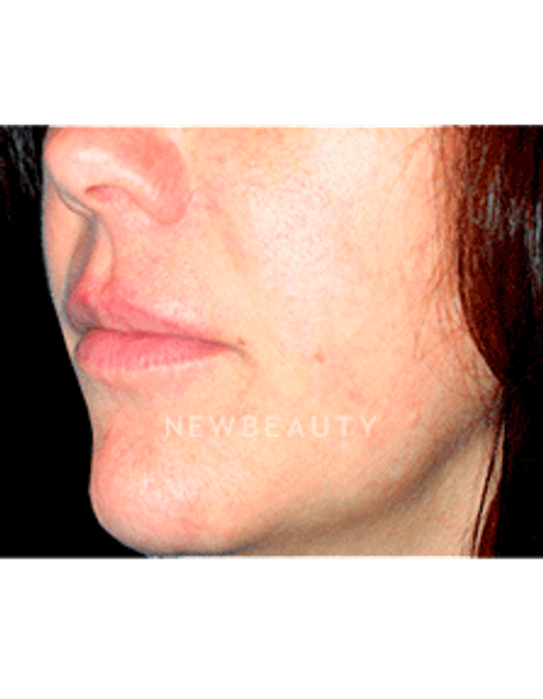 Dr. Kelly Bomer Lip Augmentation - Before