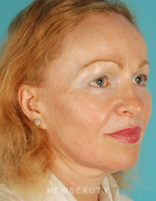 Dr. David Kim Facelift, Necklift - Before