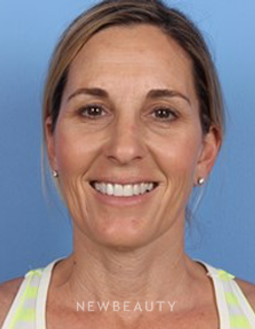 Dr. Kelly Bomer - Botox - After