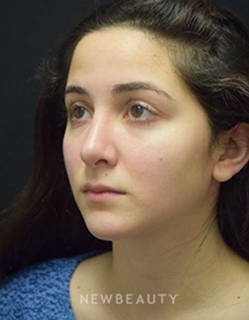 Dr. Jeffrey B. Wise - Rhinoplasty - After