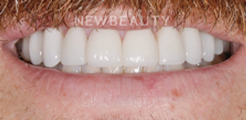 Dr. Salvator La Mastra - Smile Makeover -46107468 - After