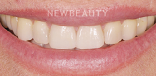 Dr. Salvator La Mastra - Veneers - 46106725 - Before