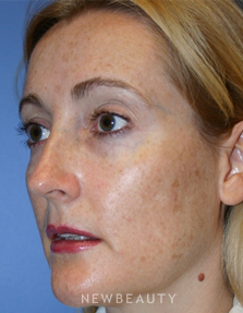 Dr. Kelly Bomer -  Chemical Peels - Before