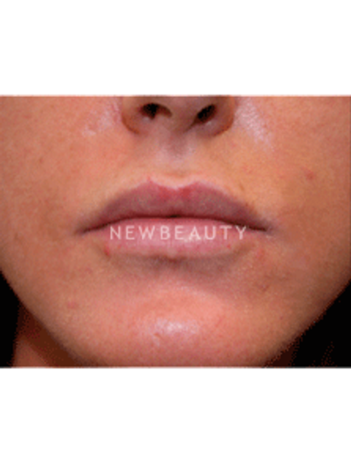 Dr. Christine Hamori Lip Augmentation - After