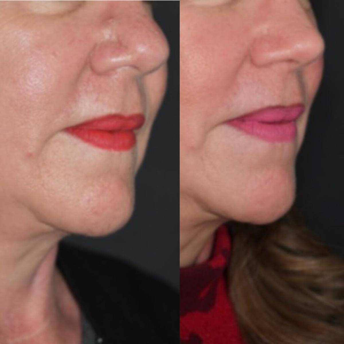 Accutane Nose Job