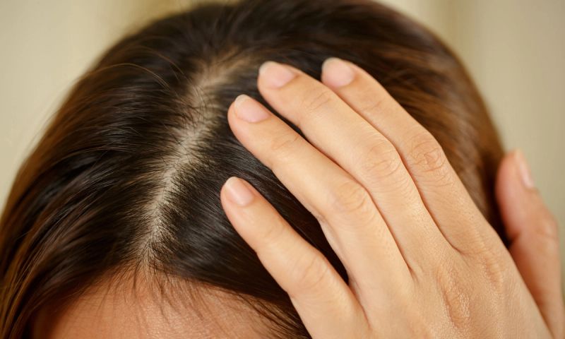 hormonal hair loss