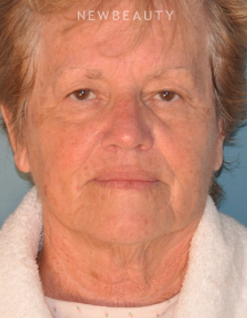 Dr. Alan Durkin - Limited Incision Facelift - Before