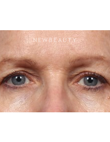 Dr. Kelly Bomer - Upper Blepharoplasty - Before