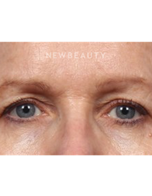 Dr. Kelly Bomer - Upper Blepharoplasty - Before