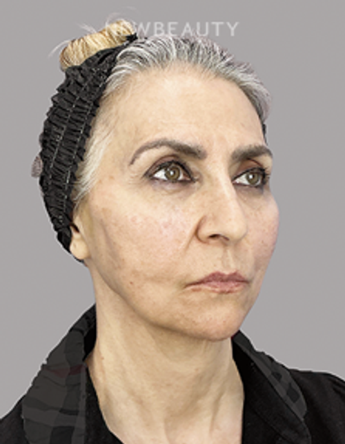Dr. Sheila Barbarino-Thread Lift-54798899 - After