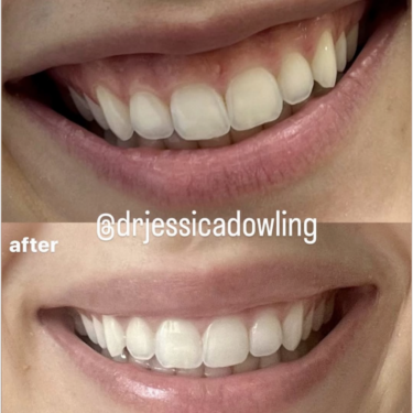lip flip before and after using Botox to reduce the look of a gummy smile
